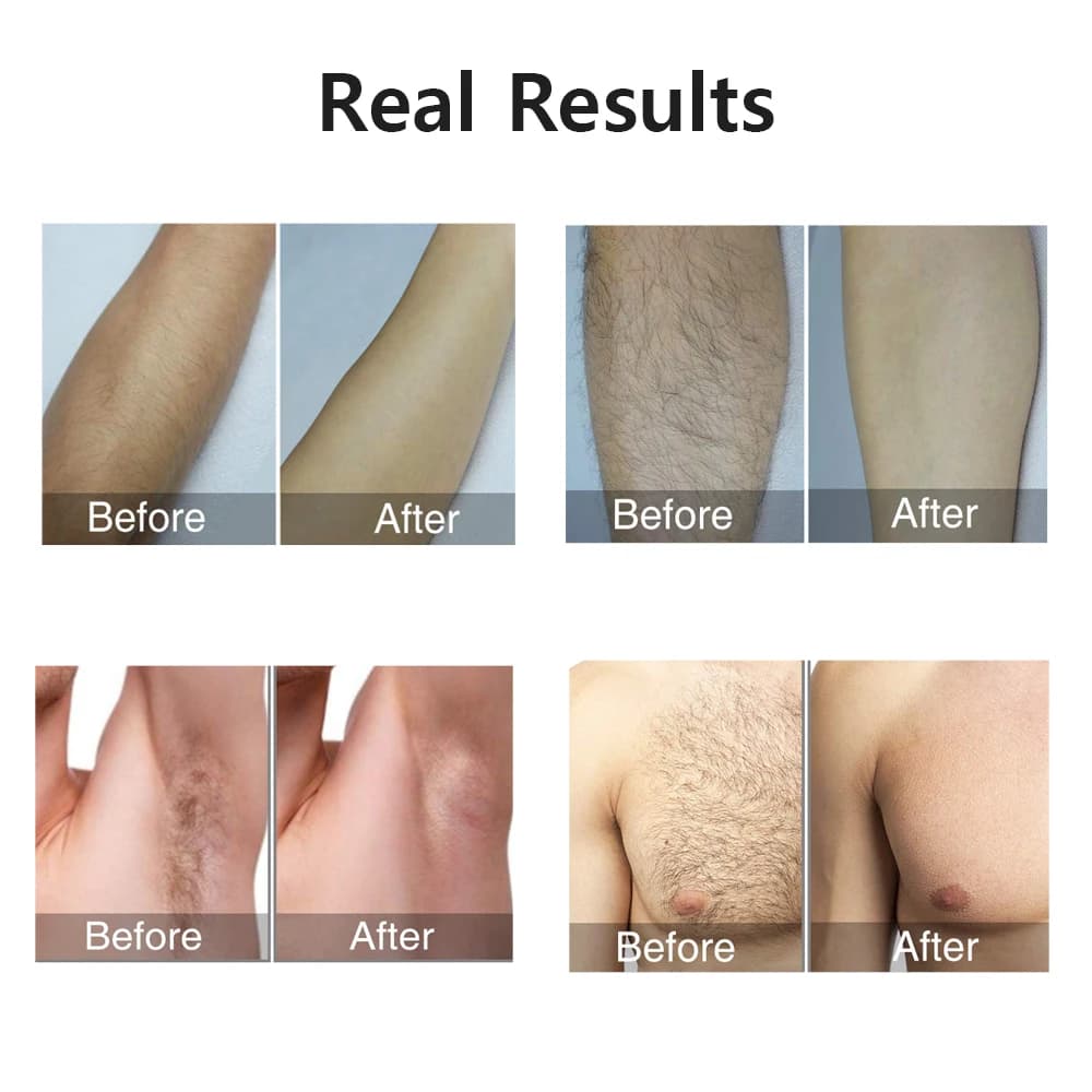 itsskk | Professional Clinical IPL Hair Removal System thumbnail 3